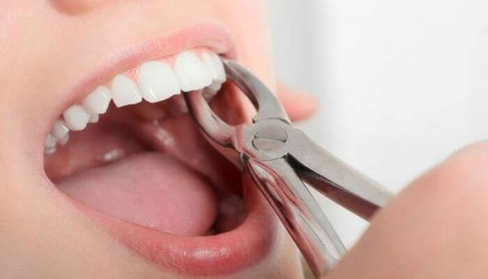 Ngủ mơ thấy nhổ răng sâu